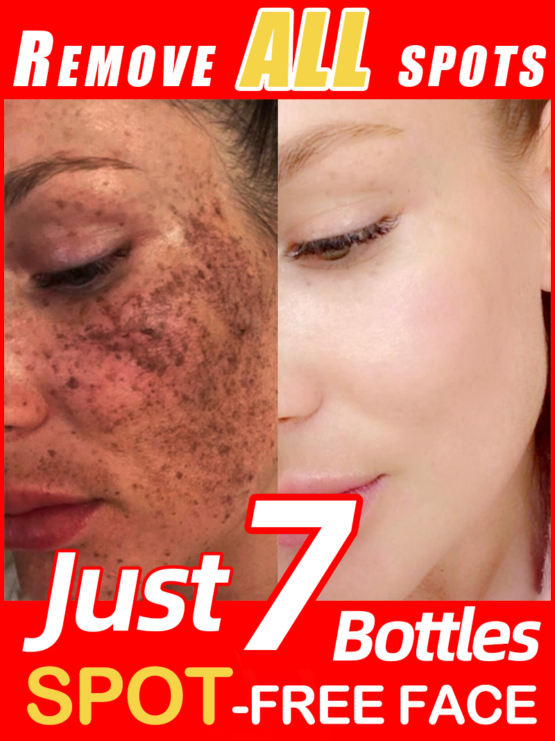 Lighten Freckles Melasma, Faci - Skincare Luxury Whitening 评论和价格